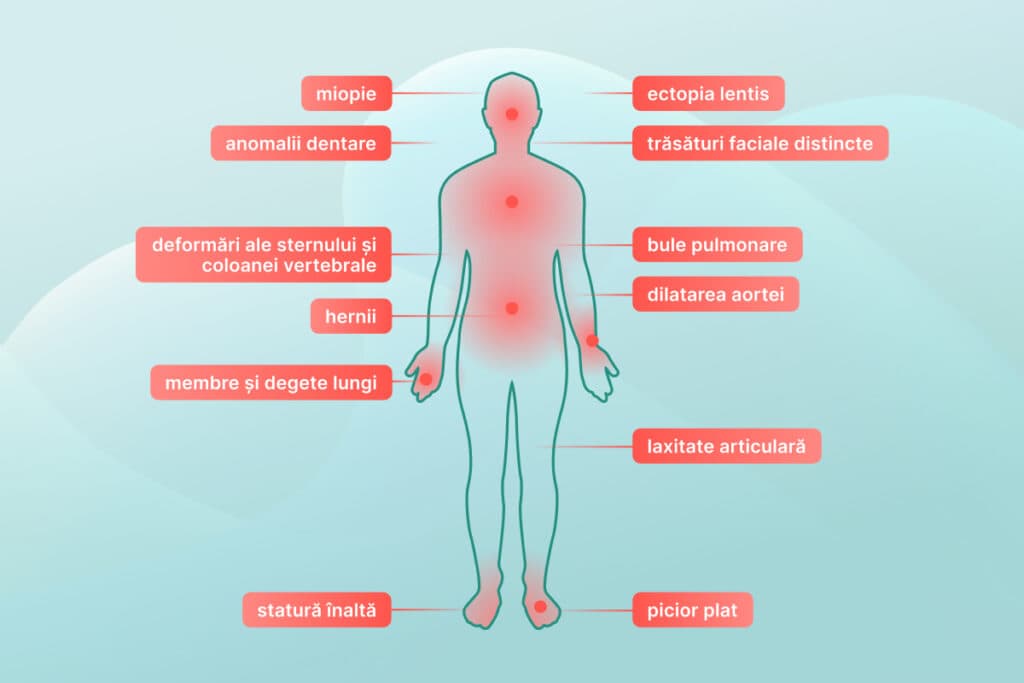 Sindromul Marfan: simptome, diagnostic și tratament eficient