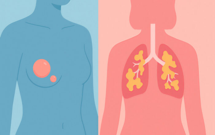 fibromatoza chistică mamară (sân) versus fibroza chistică (plămâni)