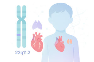 Ilustrație a deleției 22q11.2 pe cromozomul 22 cu inimă, timus și paratiroide evidențiate la un copil.